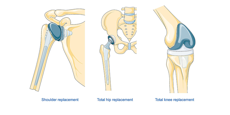 Robotic Joint Replacement