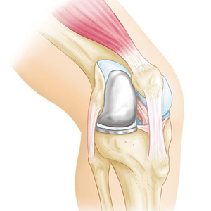 Robotic Joint Surgery