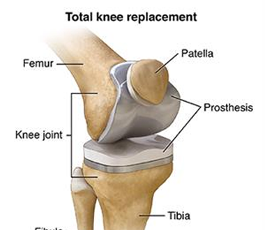 Replacement (Robotic surgeries)