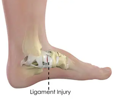 Ligament Tear (ACL,PCL)