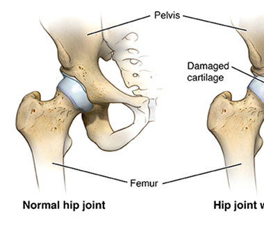 Joint preservation