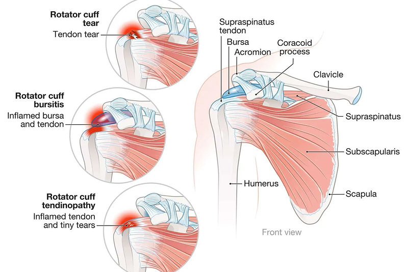 Rotator Cuff Tear